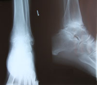Left Ankle